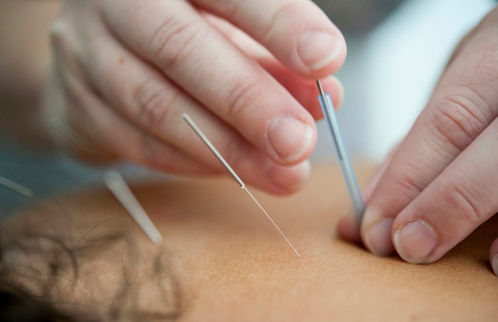 Understanding Acupuncture and Moxibustion: Ancient Wisdom for Modern Healing